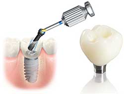 Single tooth implants dentist specialist nyc