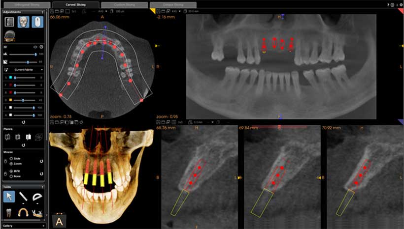 Three Dimensional Scan of Your Teeth