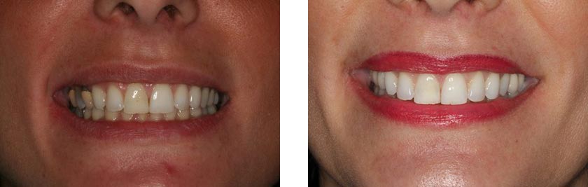 dental implants nyc before after 8
