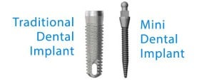 mini vs traditional dental implant placement