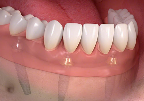 All on 4 Dental Implants in Mexico: Six Tips from Top Dentists