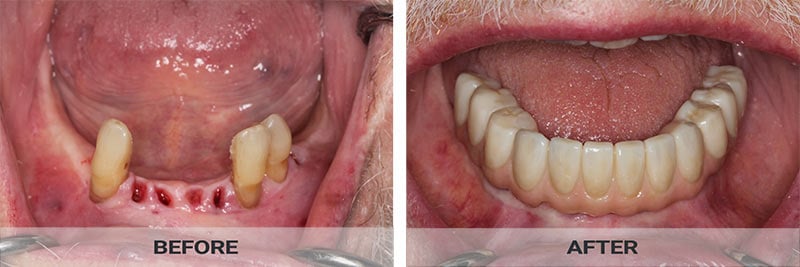 all on four dental implants | New York Implant dentist