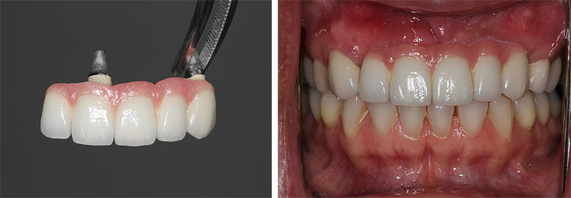 multiple tooth implants nyc | Dental Implants New York