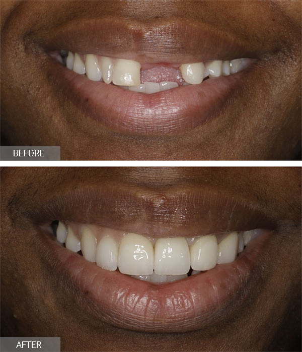 Front Tooth Implant (Top Rated NYC Dentist) - Midtown ...