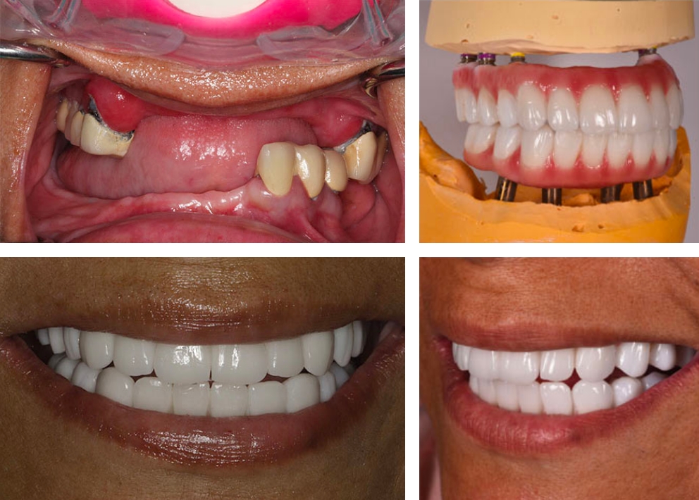 All on 4 Dental Implants A Comprehensive Smile Solution