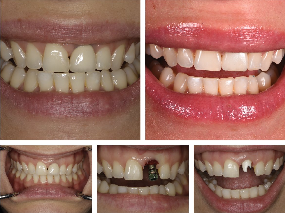 Single tooth dental implant by Dr. Navid