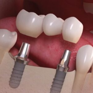 teeth-in-an-hour procedure replace missing teeth in one hour