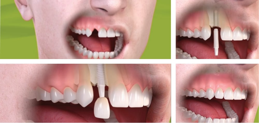 front tooth implants