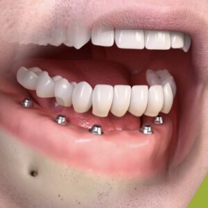 Treatment Option for missing multiple teeth | teeth in one day