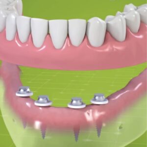 mini dental implant denture placement