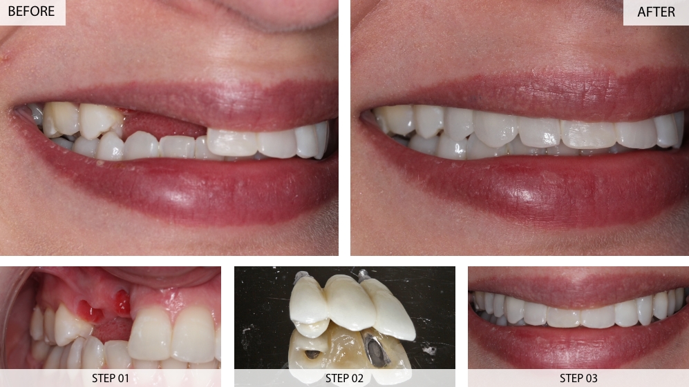 Front Teeth 3 Unit Dental Implant Bridge Before & After