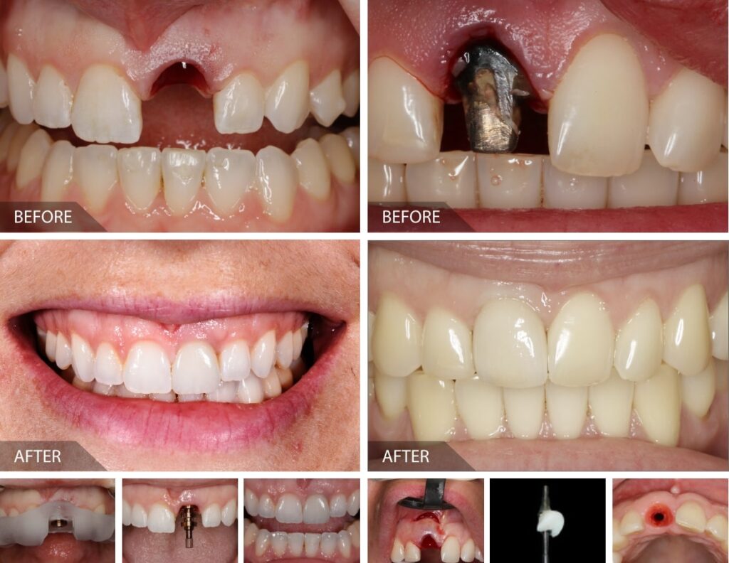 Front tooth dental implants results