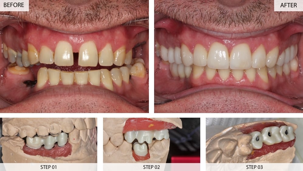 Full Mouth Rehab Multiple Dental Implants & Veneers Before & After