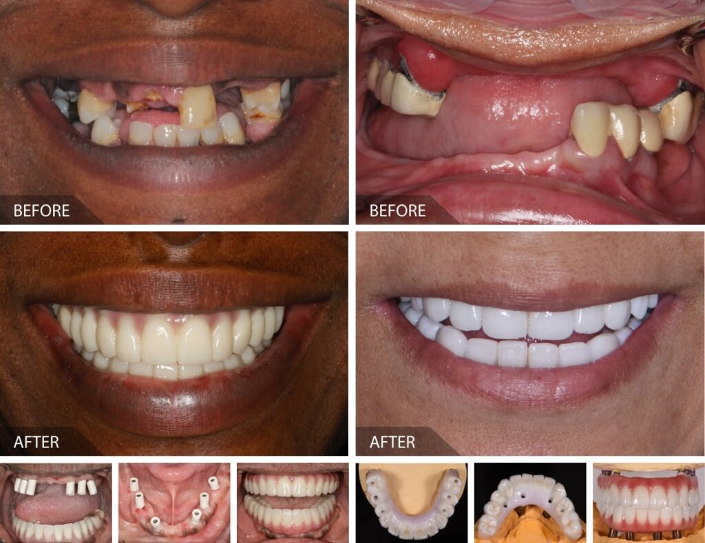 full mouth dental implants results