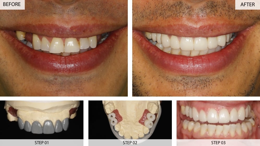 Multiple dental implants case 3