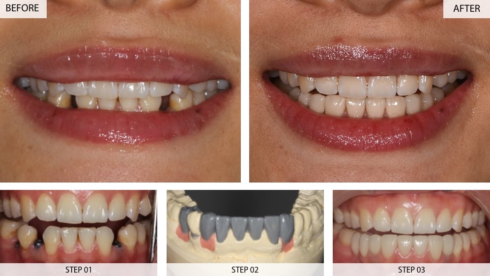 Multiple dental implants case