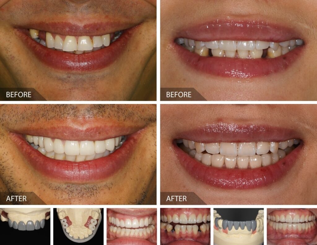 Multiple dental implants results