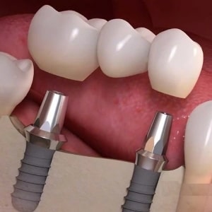 Treatment Option for missing multiple teeth implant bridge