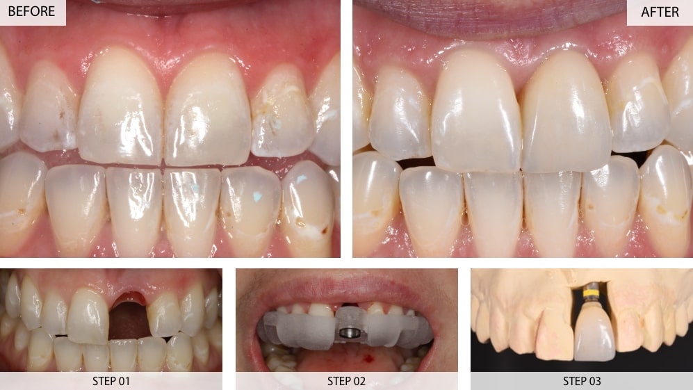 Dental Implants Results (Before & After) 22 Cases