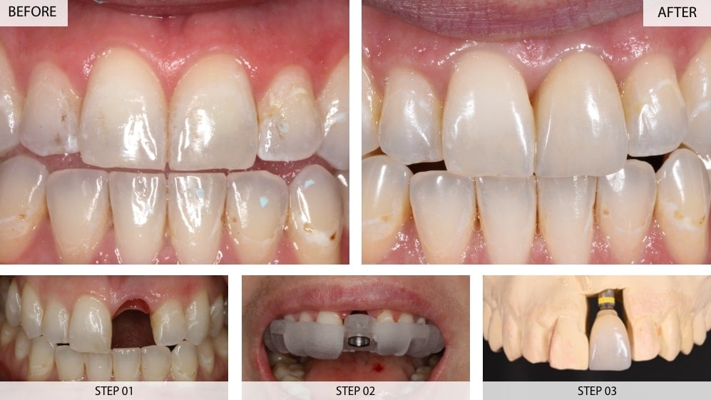 Front tooth implant | before and after result