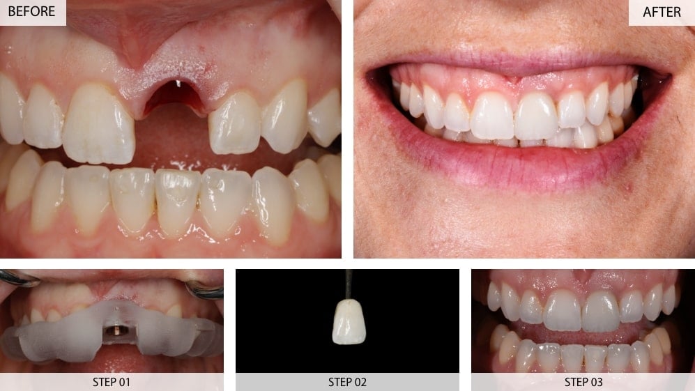 front tooth dental implants before after case