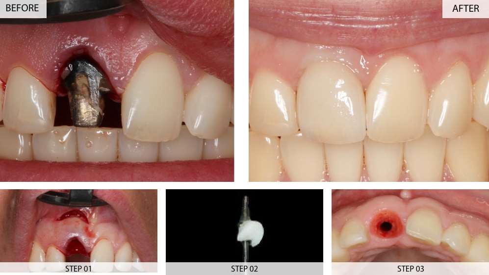 front tooth dental implants before after case