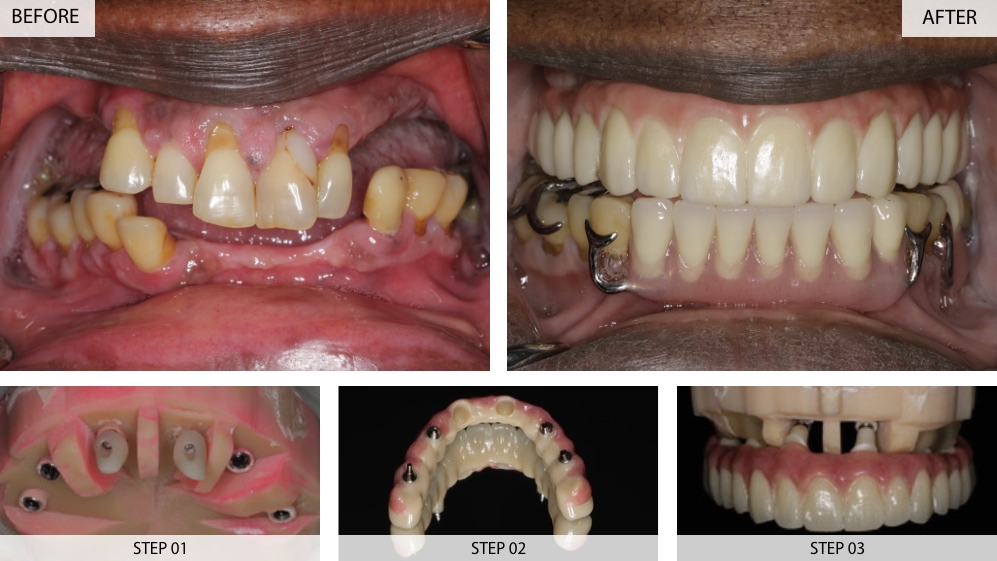 Dental Implants Results (Before & After) 22 Cases
