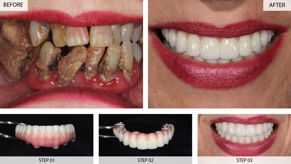 Tooth Implant Before After