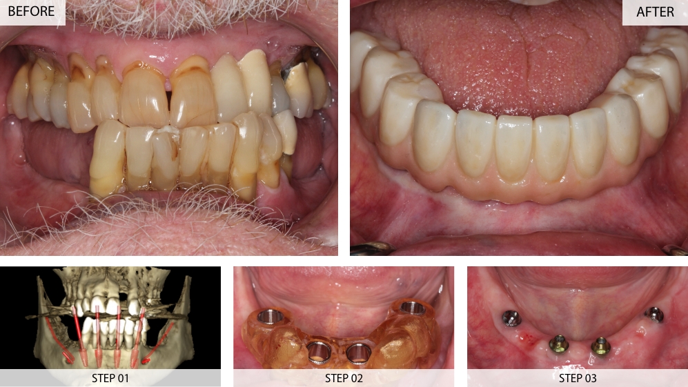 Dental Implants Results (Before & After) 22 Cases