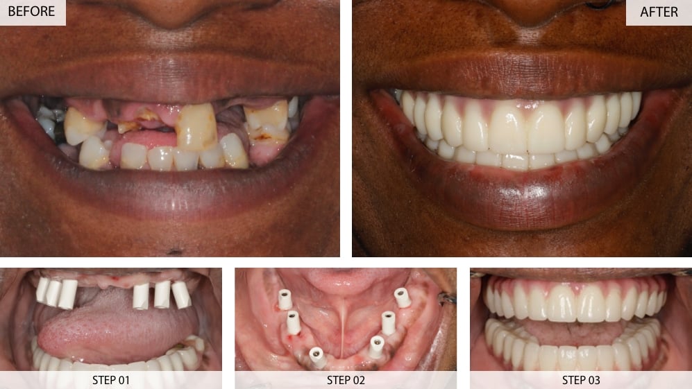 full mouth all on 4 dental implants case 8