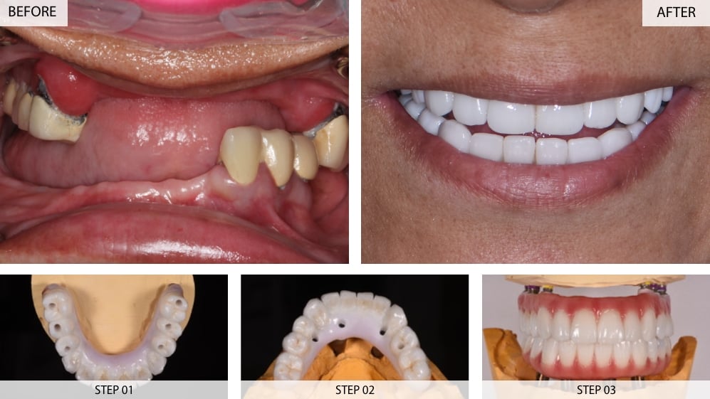 Dental Implants Results (Before & After) 22 Cases