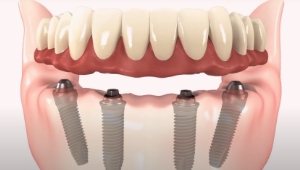 missing full mouth implants multiple dental implants