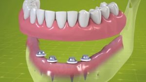 missing full mouth replace mini implants