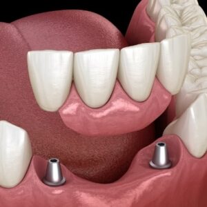 teeth in an hour dental implant