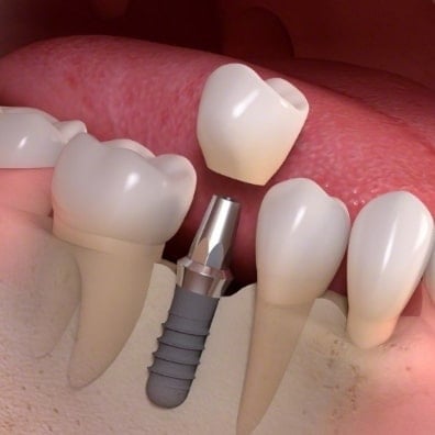 teeth in an hour dental implants