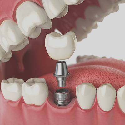 Dental Implant Surgery