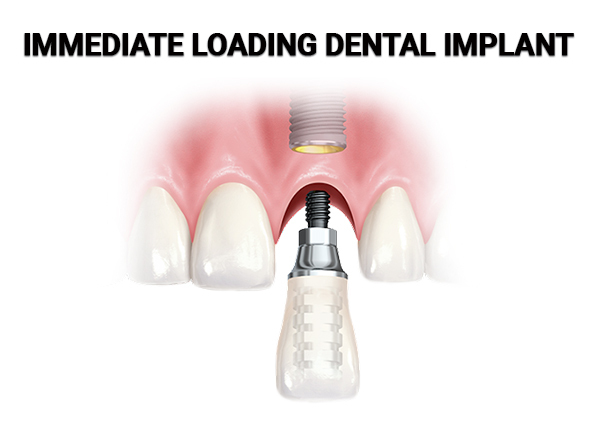 Immediate Loading Dental Implant