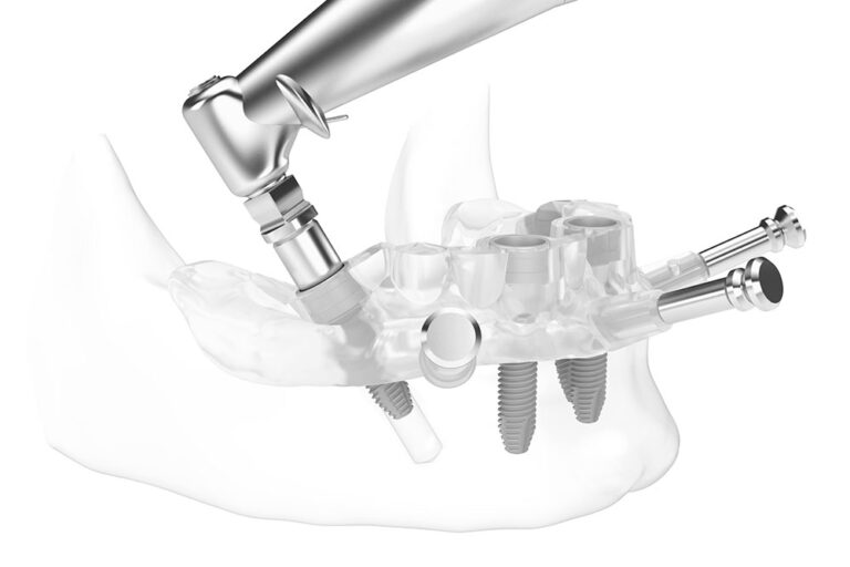 Computer Guided Implant Stent NYC Dental Implants Manhattan NY