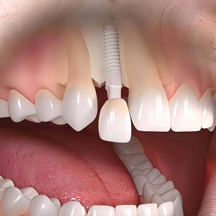 Front Tooth Implants