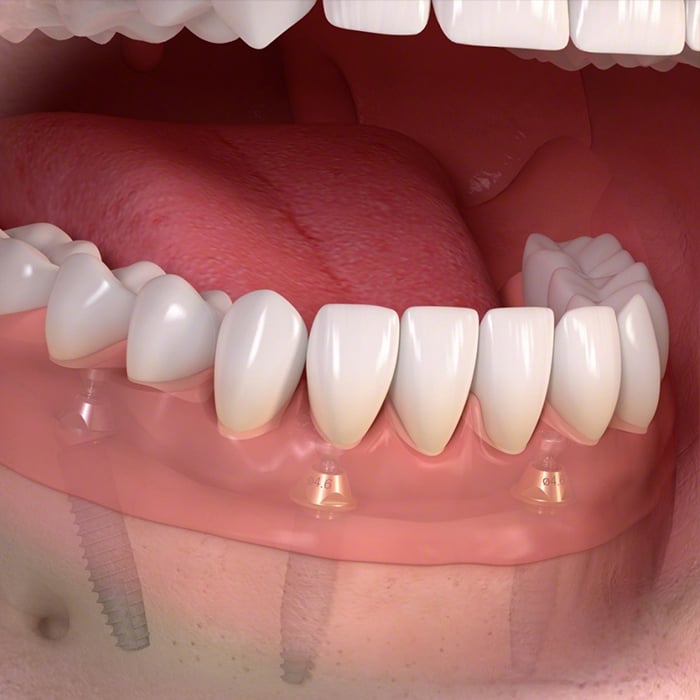 All-on-4 Dental Implants - Midtown NYC