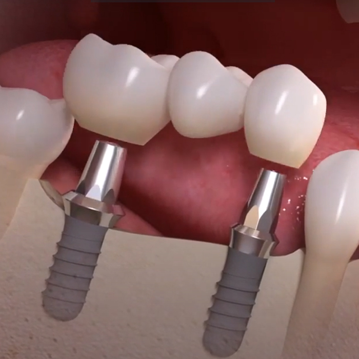 Multiple Teeth Implants Dentist Specialist Midtown NYC