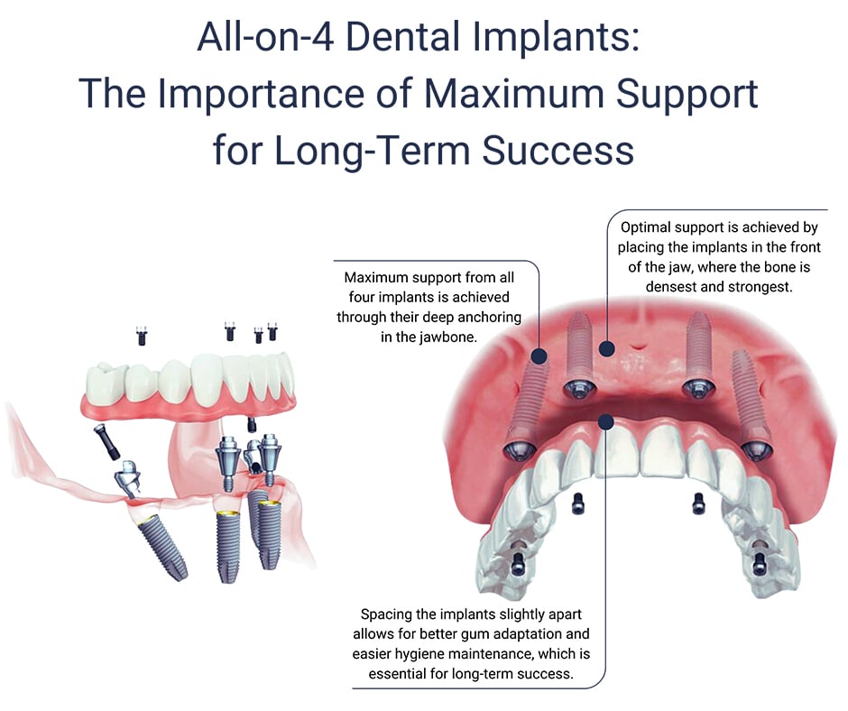 All-on-4-Dental Implants for Maximum Support