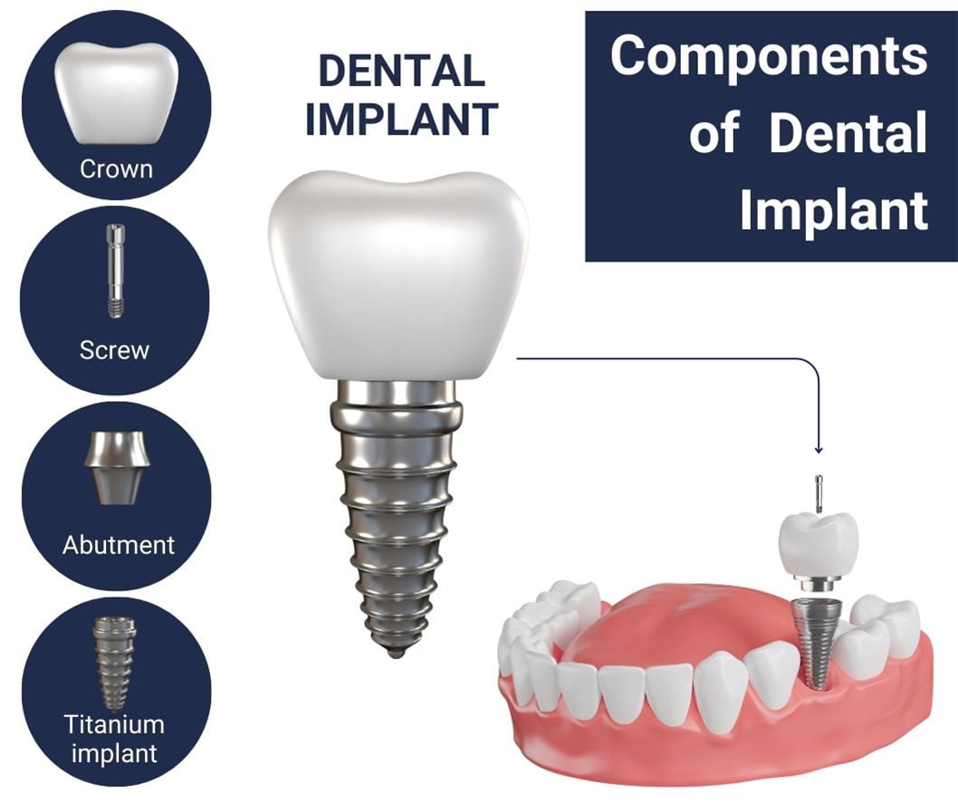 Dental Implant Components