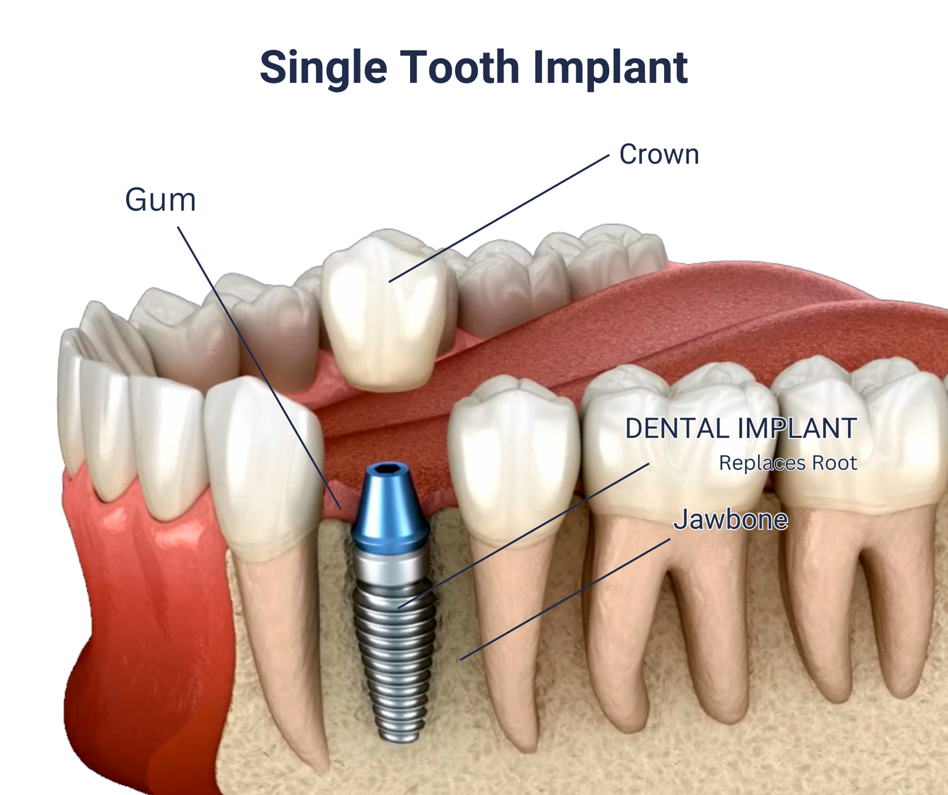 Treatment options for missing single tooth infographics