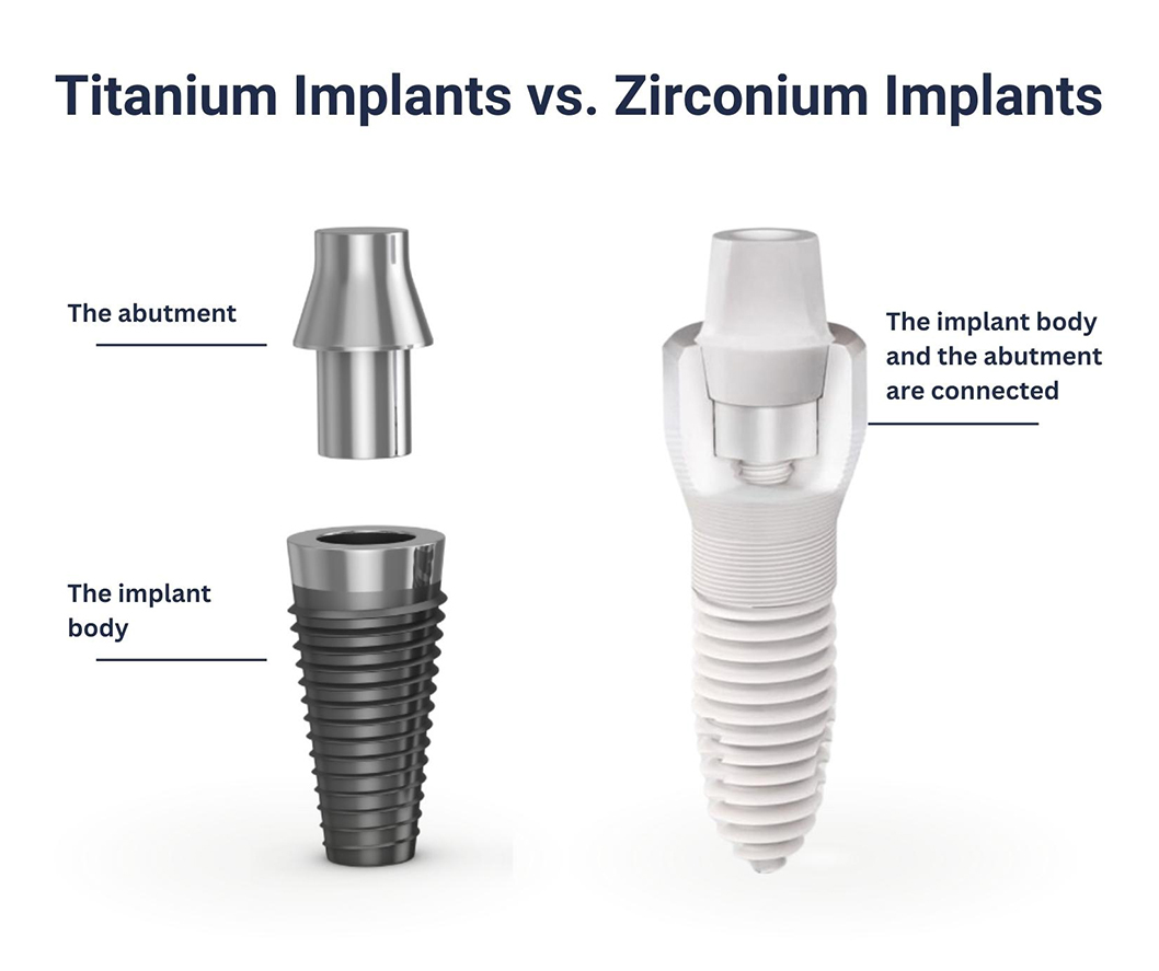 Titanium vs Zirconium Implants