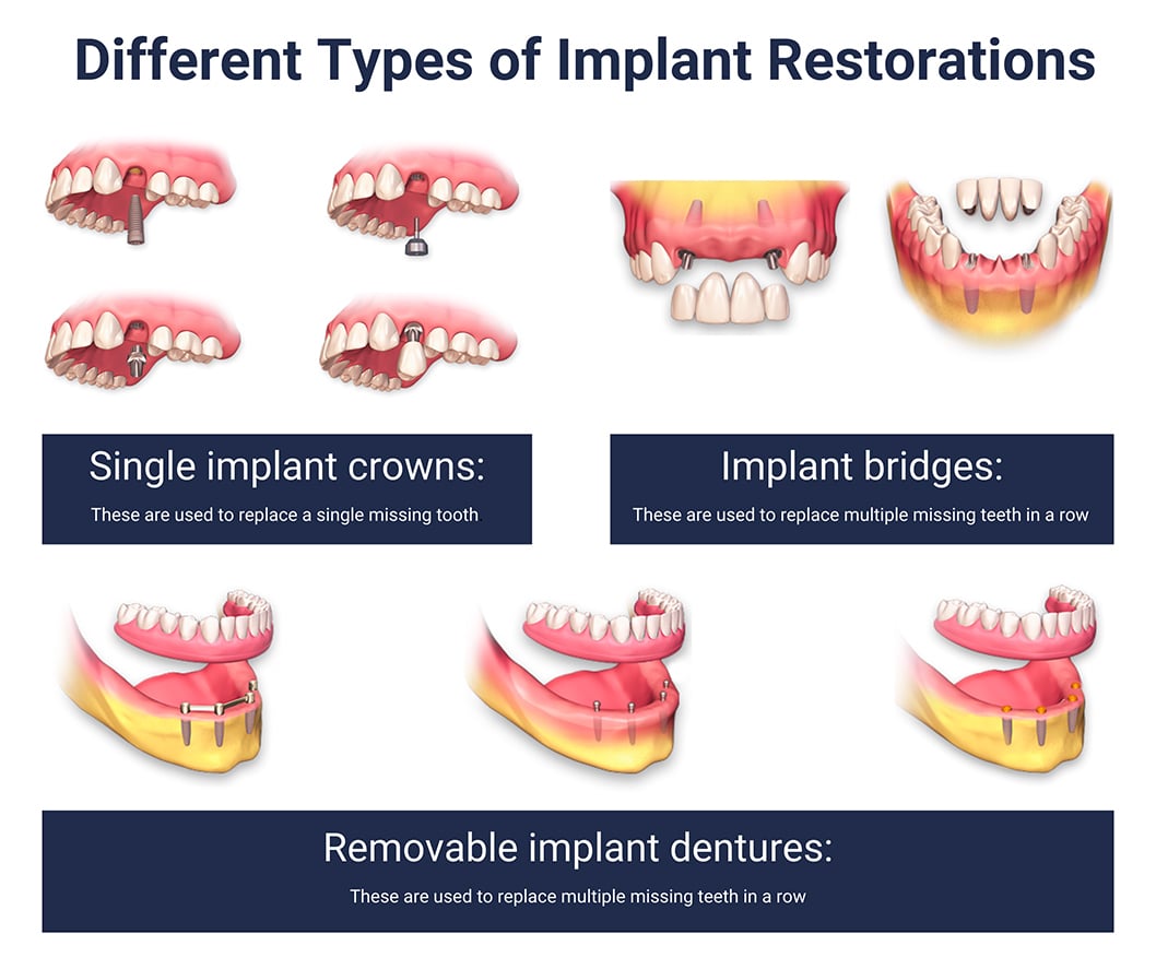 Types of Implant Restorations