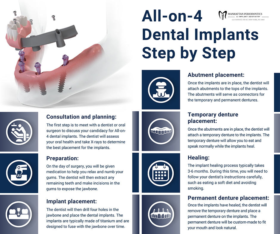 All-on-4 Dental Implants - Step-by-step Process Infographics