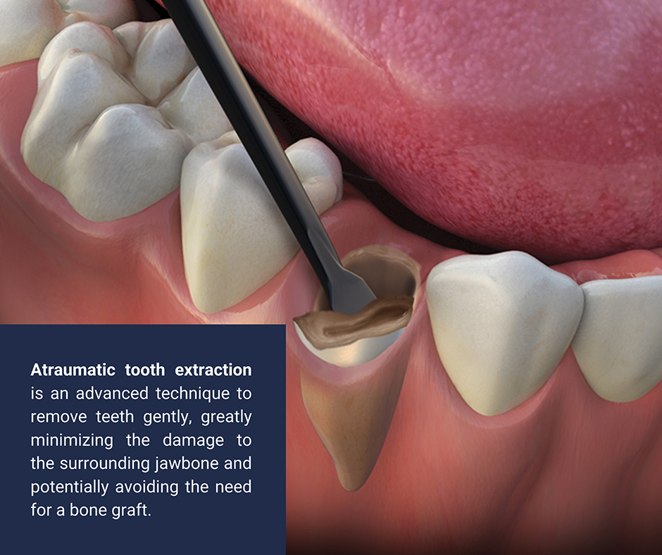 Atraumatic Tooth Extractions