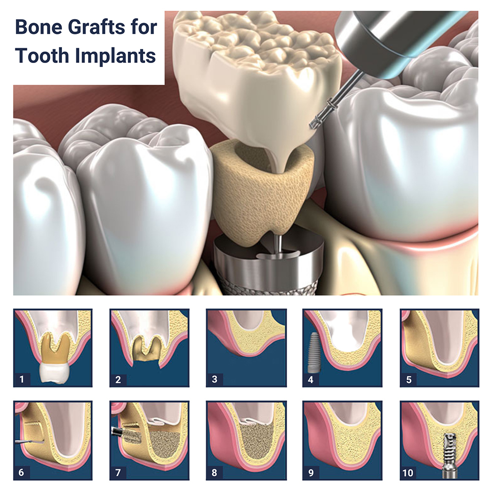 Bone Grafts for Tooth Implants