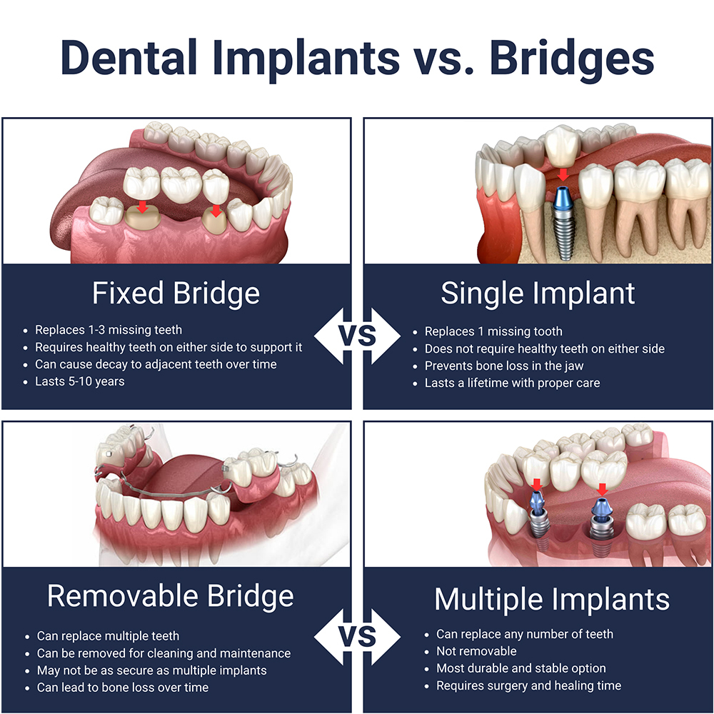 Dental Implants vs Bridges